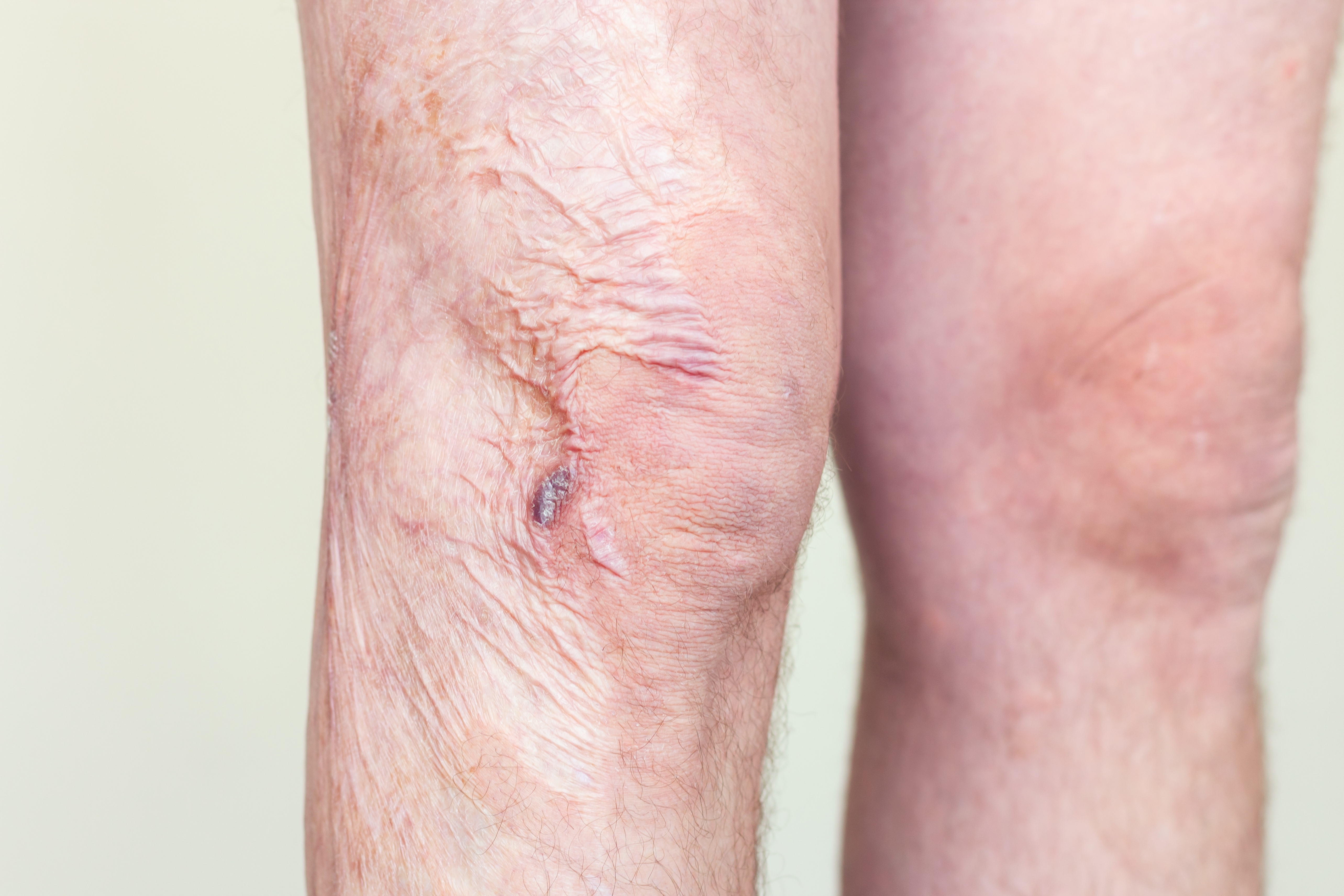 구축 교정 (관절·경부)