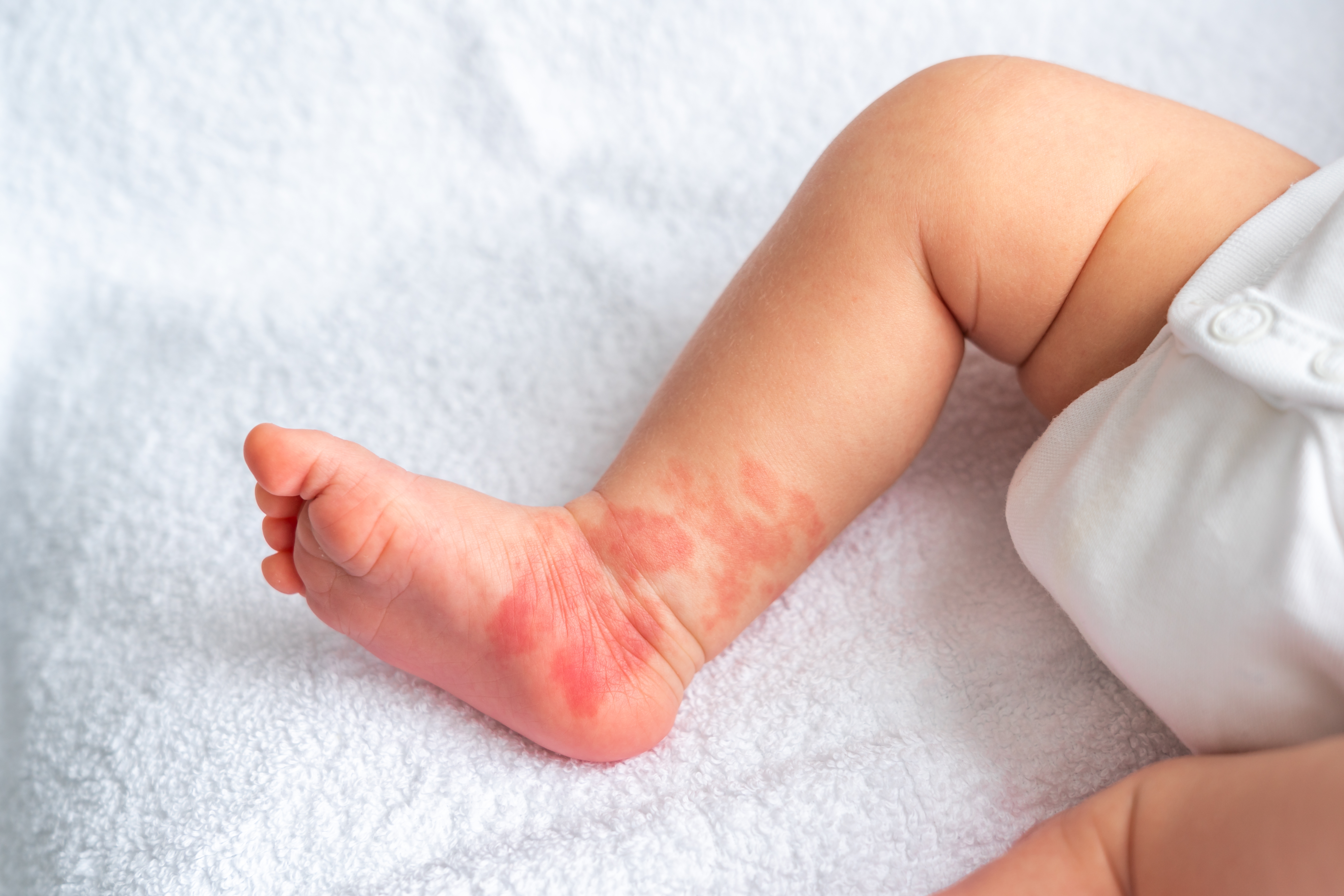 소아 모반 (점·멍울) 제거